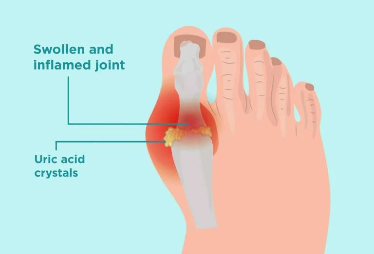 Uric Acid Gout Joint Pain